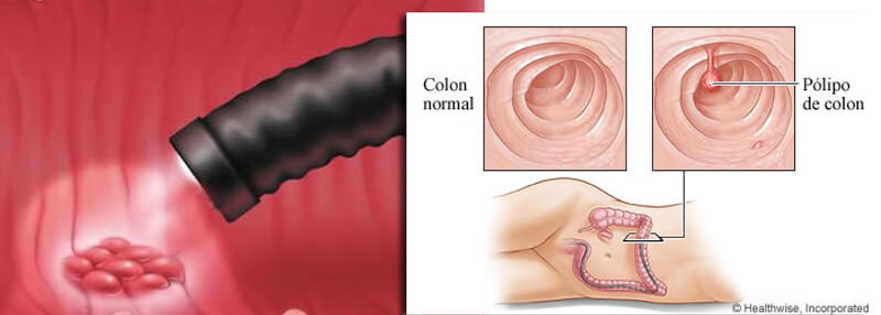El cáncer de colon y la colonoscopia