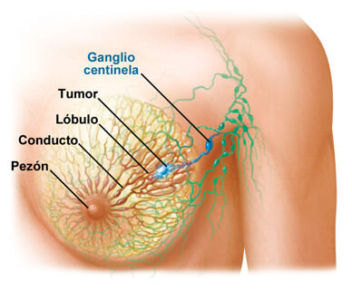 Cáncer de mama (hembras)