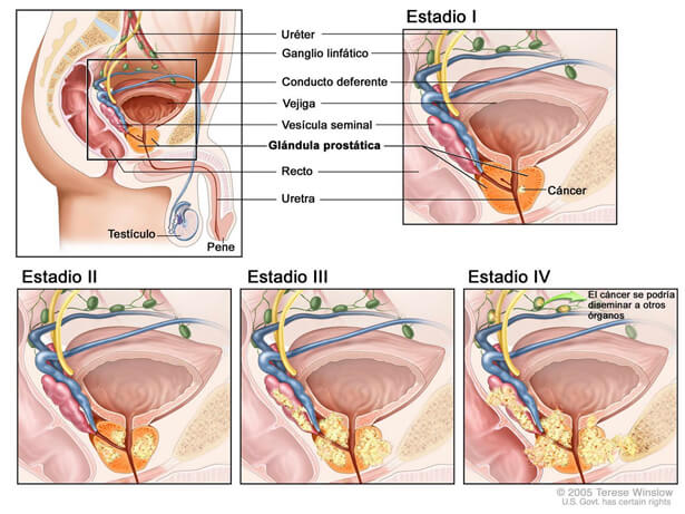 >Cáncer de próstata