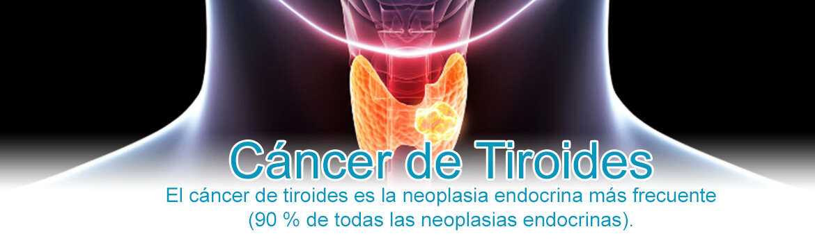 Cáncer de Tiroides